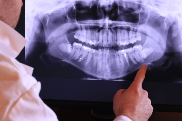 Best Emergency Wisdom Teeth Removal in Lawrenceville, NJ